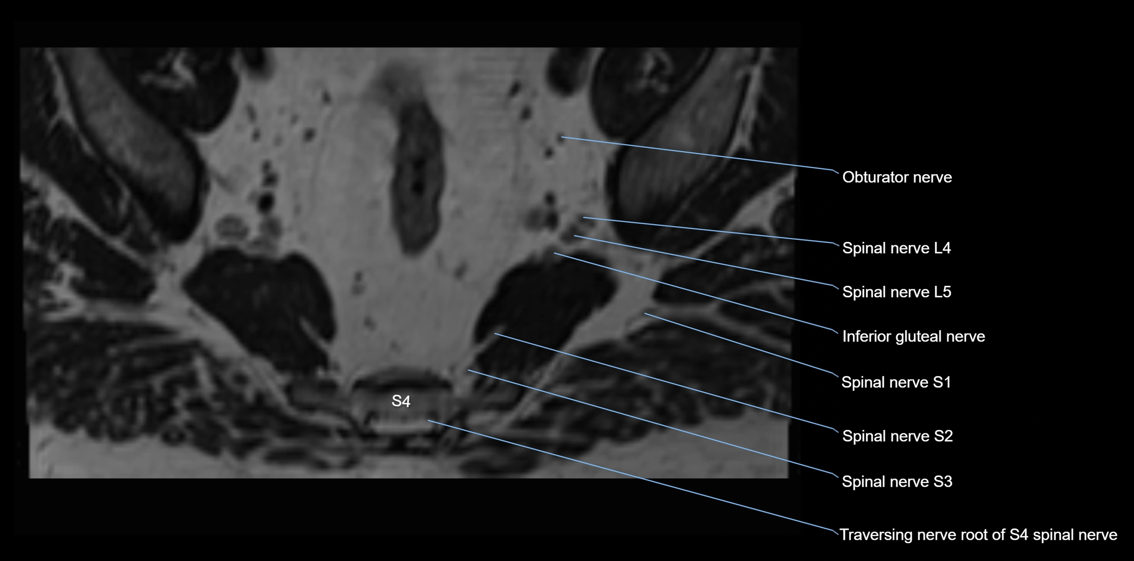 MR lumbosacral plexus axial cross sectional anatomy 3T  radiology  image-img-1008001-00097.webp